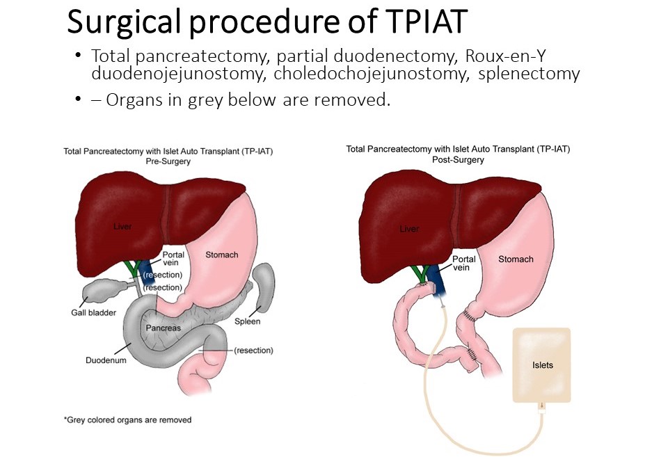 Surgical Procedure of TPIAT